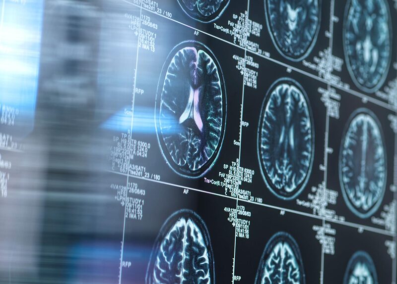 Sanjay Gupta Brain Scans, Alzheimer's